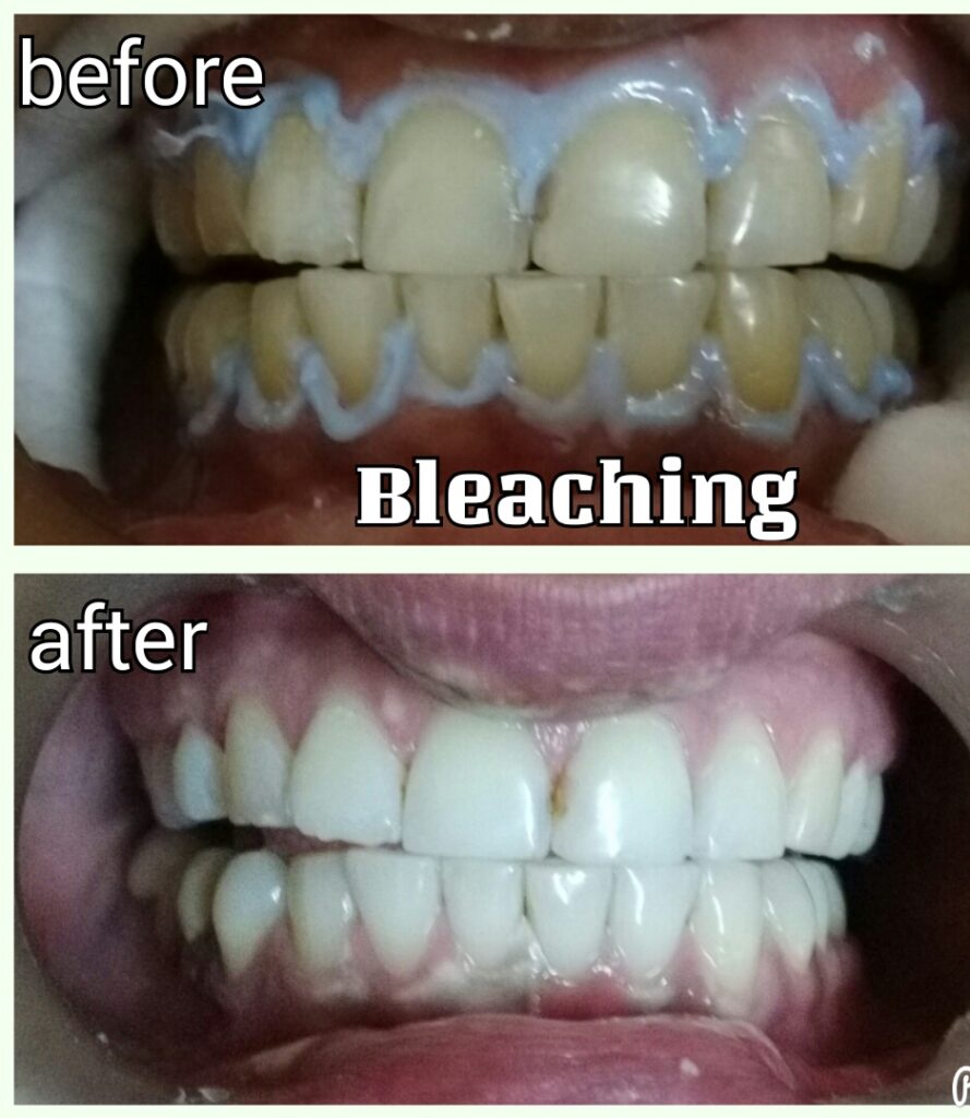 Teeth Whitening