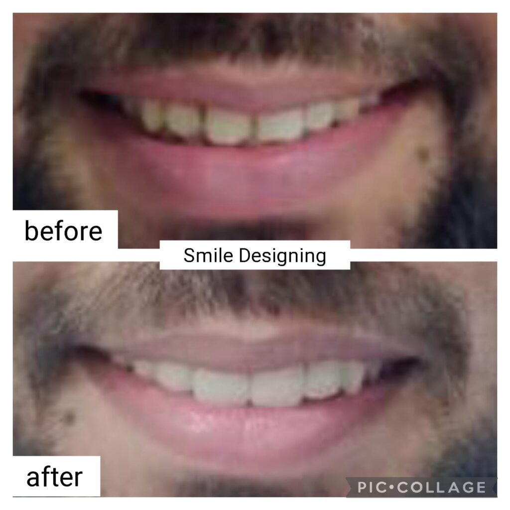 Smile Designing