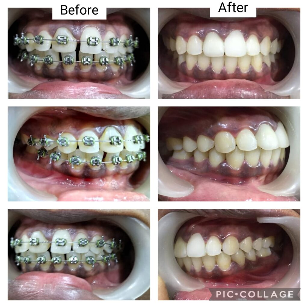 Orthodontics and Aligners