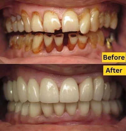 Full Mouth Rehabilitation