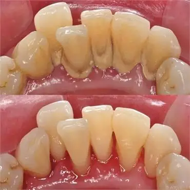 Teeth Scaling & Root Planing